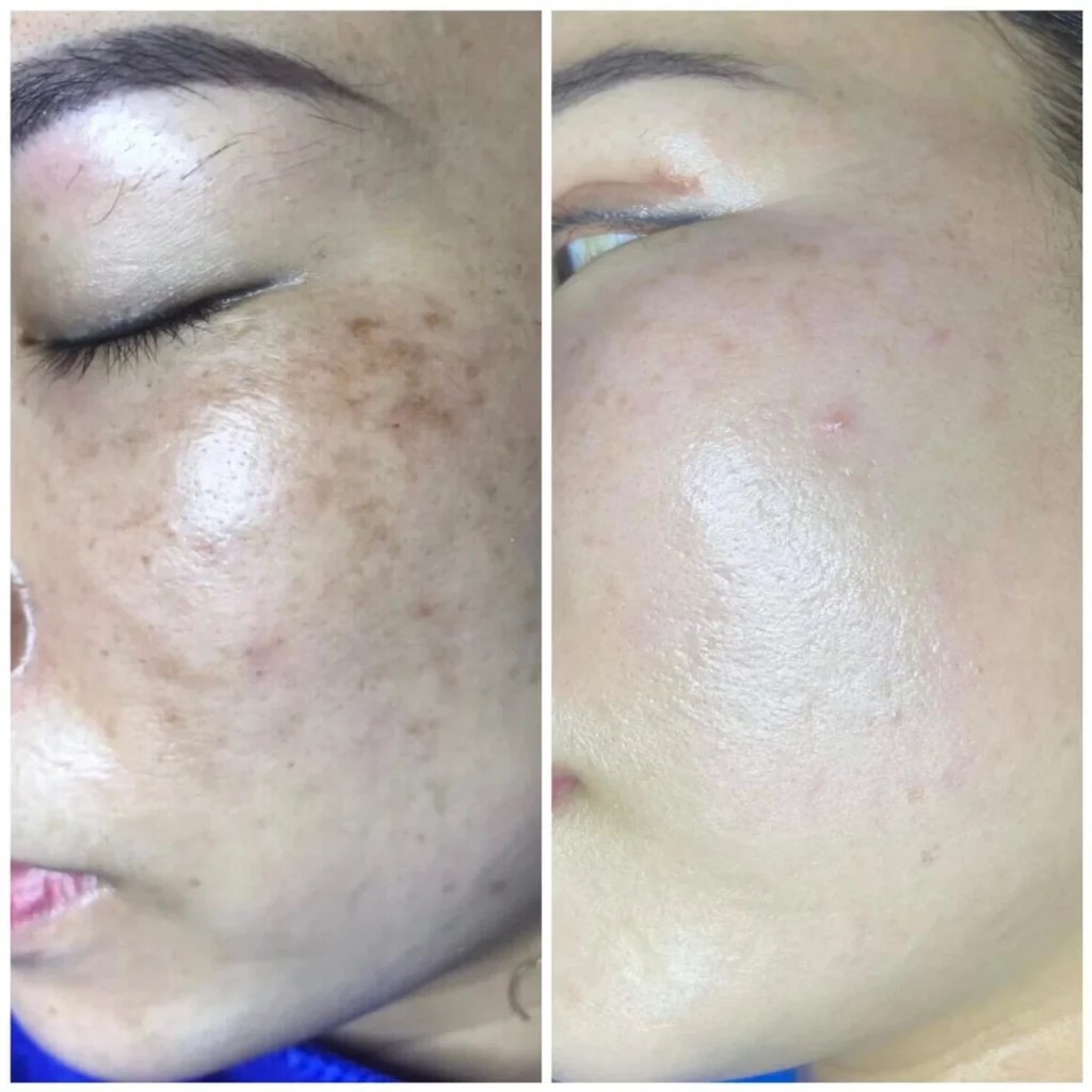 Tiêm Meso Bao Lâu 1 Lần Để Đạt Hiệu Quả Tối Ưu và Duy Trì Làn Da Rạng Rỡ?